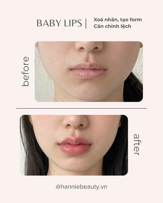 Baby Lips trước và sau