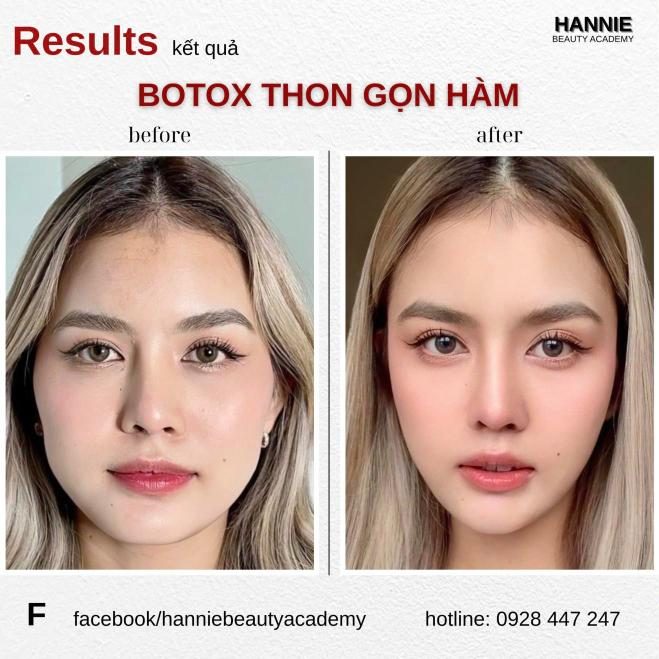 Botox thon gọn hàm trước và sau