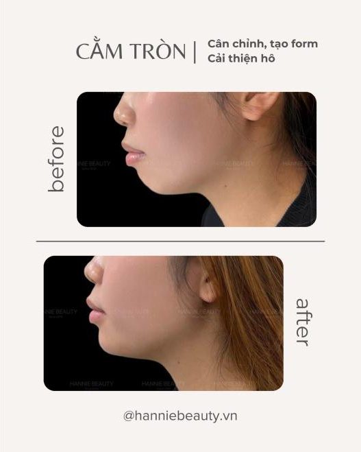 Cằm tròn trước và sau