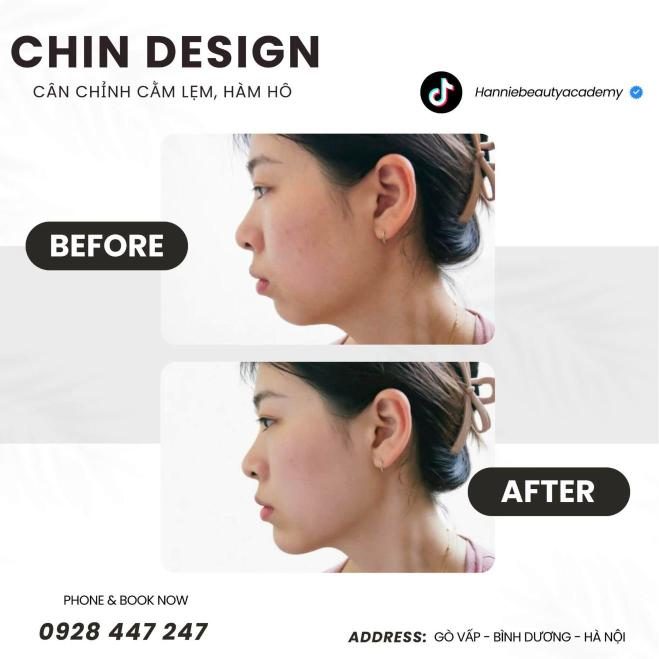 Chin design cằm lẹm trước và sau