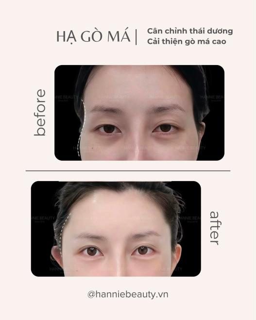 Hạ gò má trước và sau