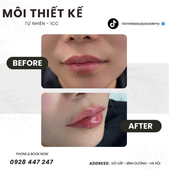 Môi thiết kế tự nhiên 1cc trước và sau