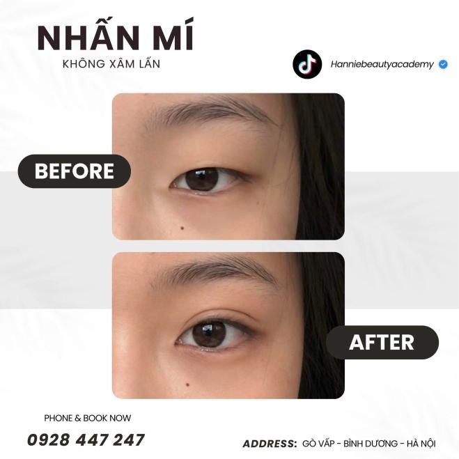 Nhấn mí trước và sau