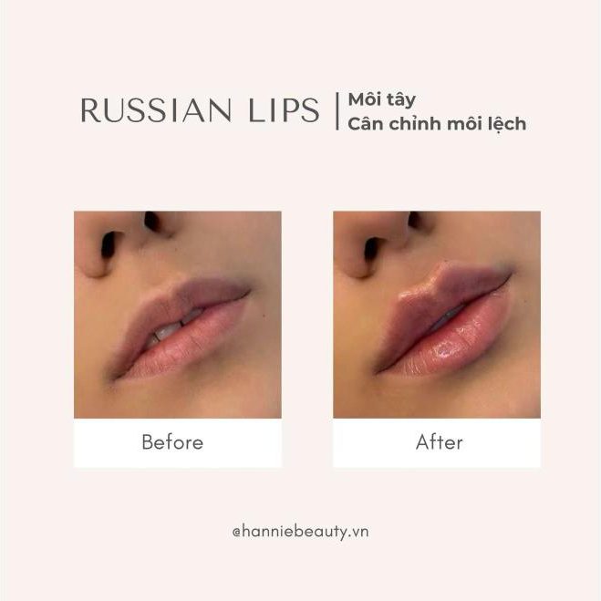 Russian Lips trước và sau