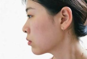 Góc nghiêng sau khi tiêm cằm