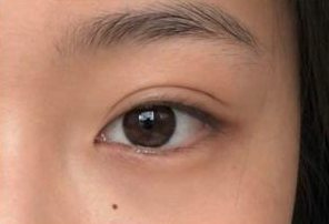 Mắt hai mí sau khi nhấn mí